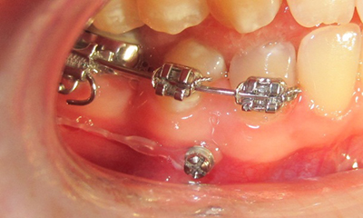 miniimplantát